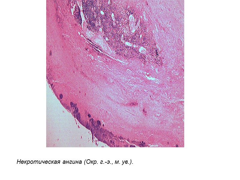 Некротическая ангина (Окр. г.-э., м. ув.).